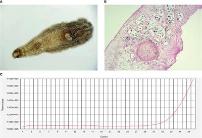 Co-infection of hepatitis E virus, Clonorchis sinensis, and Escherichia coli: A case report